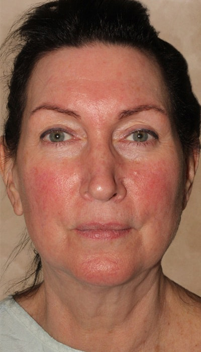 Facelift Before & After Image