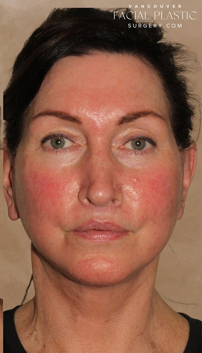 Facelift Before & After Image