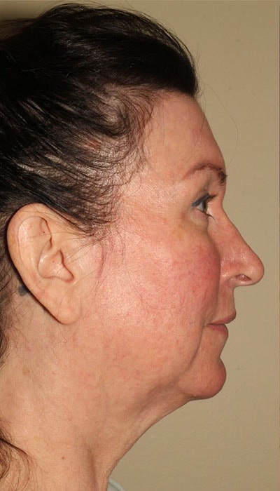 Facelift Before & After Image