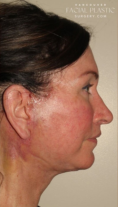 Facelift Before & After Image