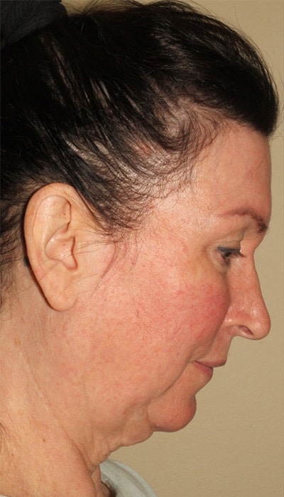 Facelift Before & After Image