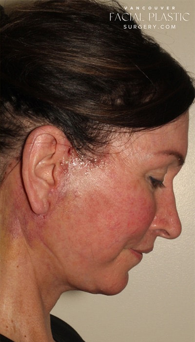 Facelift Before & After Image