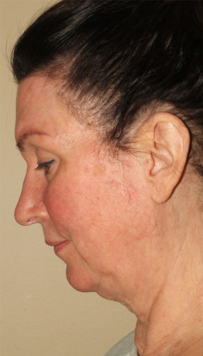 Facelift Before & After Image