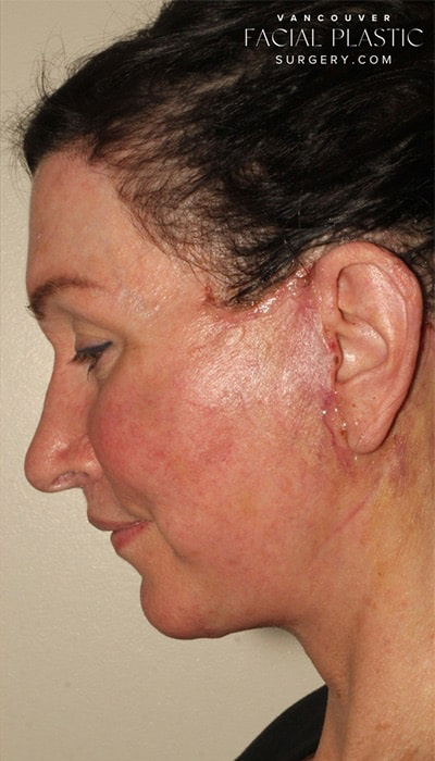 Facelift Before & After Image