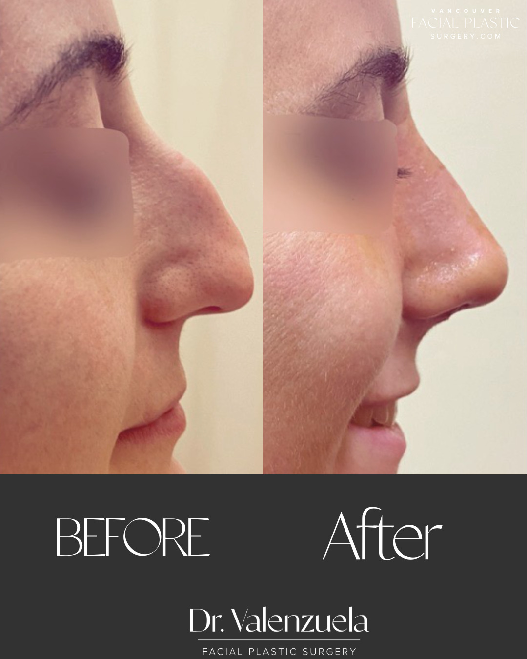 Rhinoplasty Before & After Image