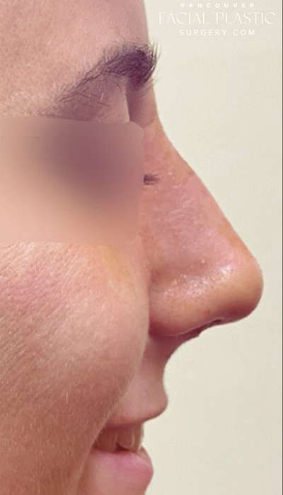 Rhinoplasty Before & After Image