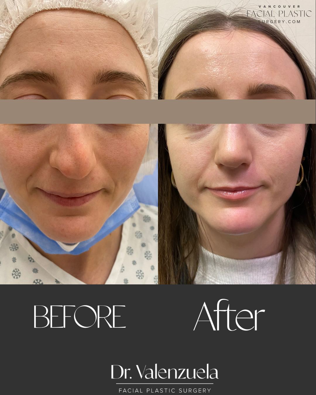 Rhinoplasty Before & After Image