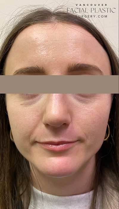 Rhinoplasty Before & After Image