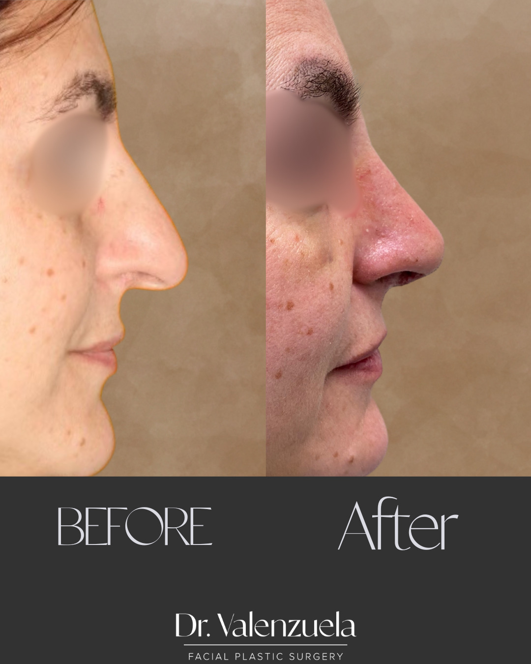 Rhinoplasty Before & After Image
