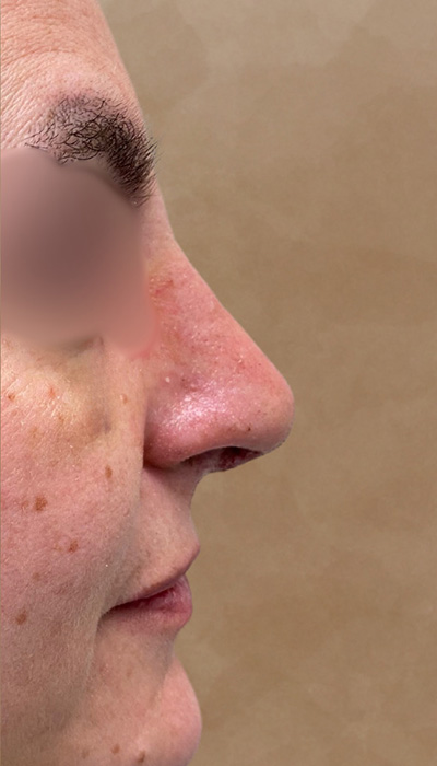 Rhinoplasty Before & After Image