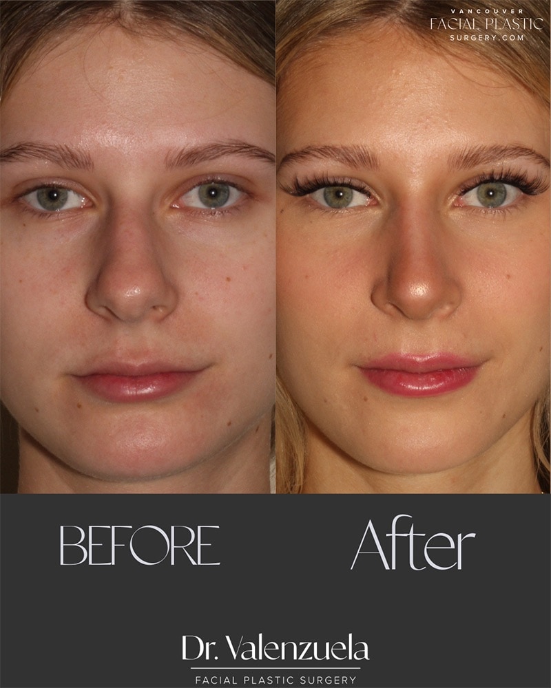 Rhinoplasty Before & After Image