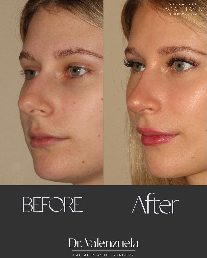 Rhinoplasty Before & After Image