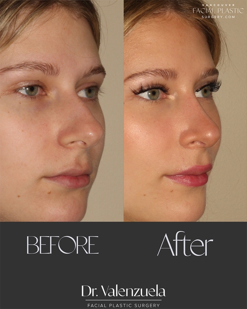 Rhinoplasty Before & After Image