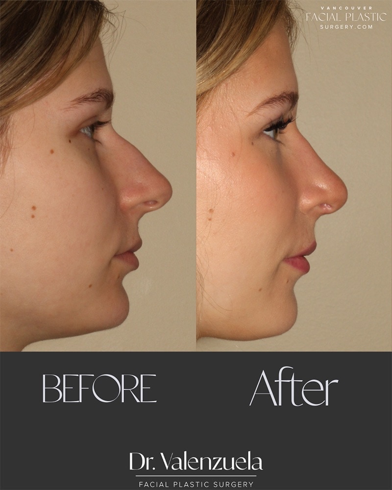 Rhinoplasty Before & After Image