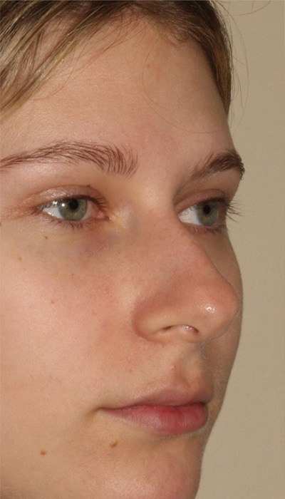 Rhinoplasty Before & After Image