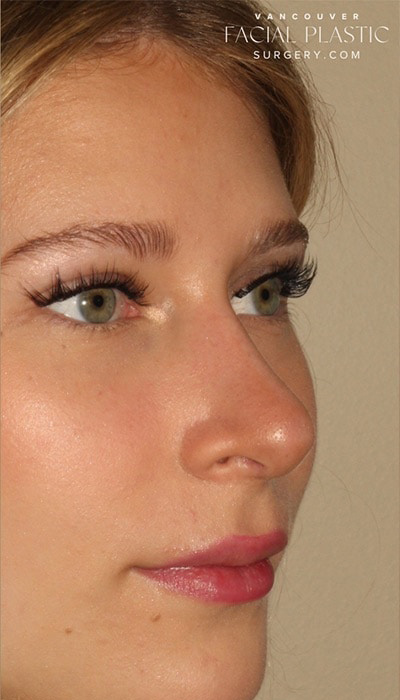 Rhinoplasty Before & After Image