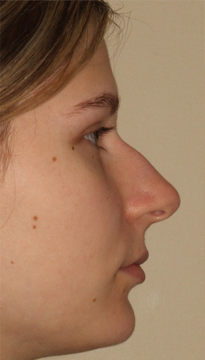 Rhinoplasty Before & After Image
