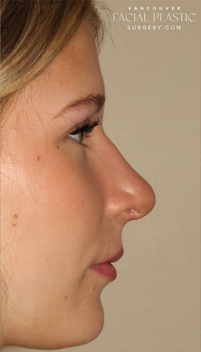 Rhinoplasty Before & After Image
