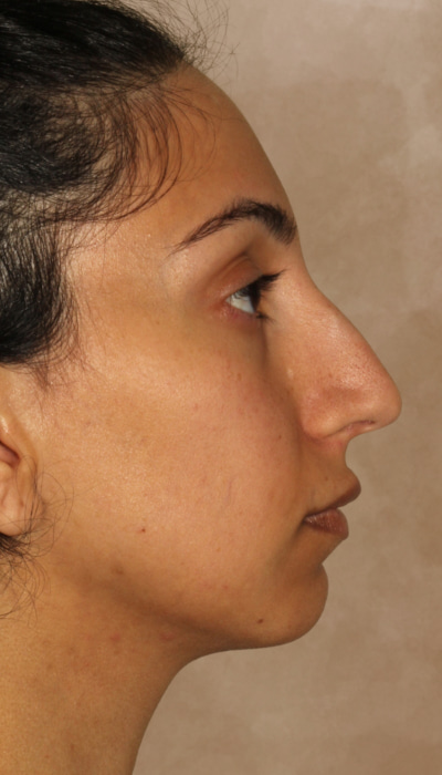 Rhinoplasty Before & After Image