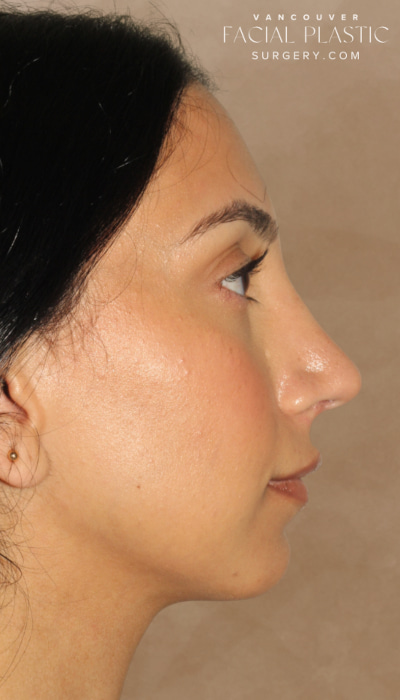 Rhinoplasty Before & After Image