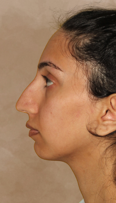 Rhinoplasty Before & After Image