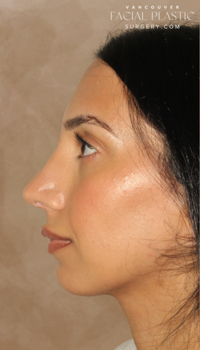 Rhinoplasty Before & After Image