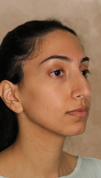 Rhinoplasty Before & After Image