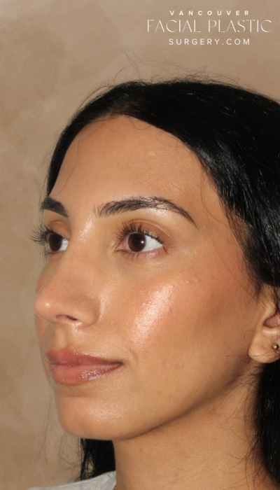 Rhinoplasty Before & After Image