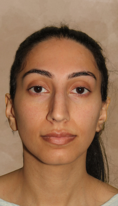 Rhinoplasty Before & After Image