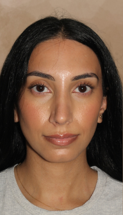 Rhinoplasty Before & After Image