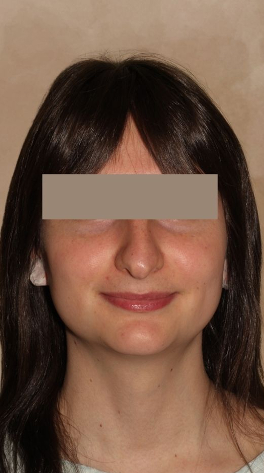 Rhinoplasty Before & After Image