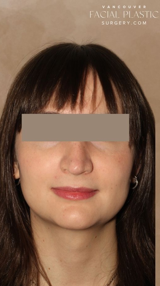 Rhinoplasty Before & After Image