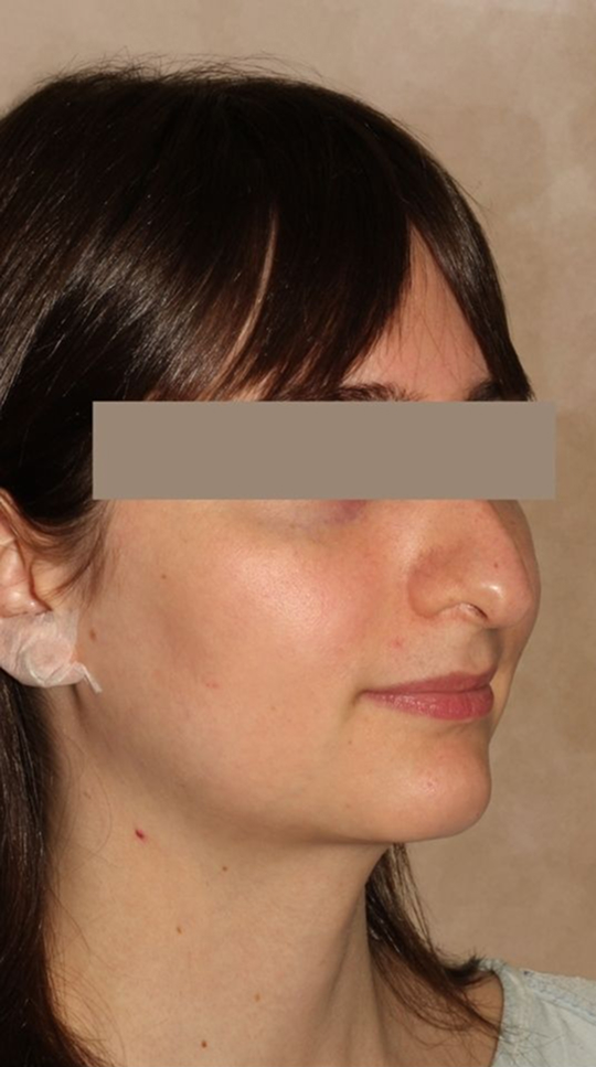 Rhinoplasty Before & After Image