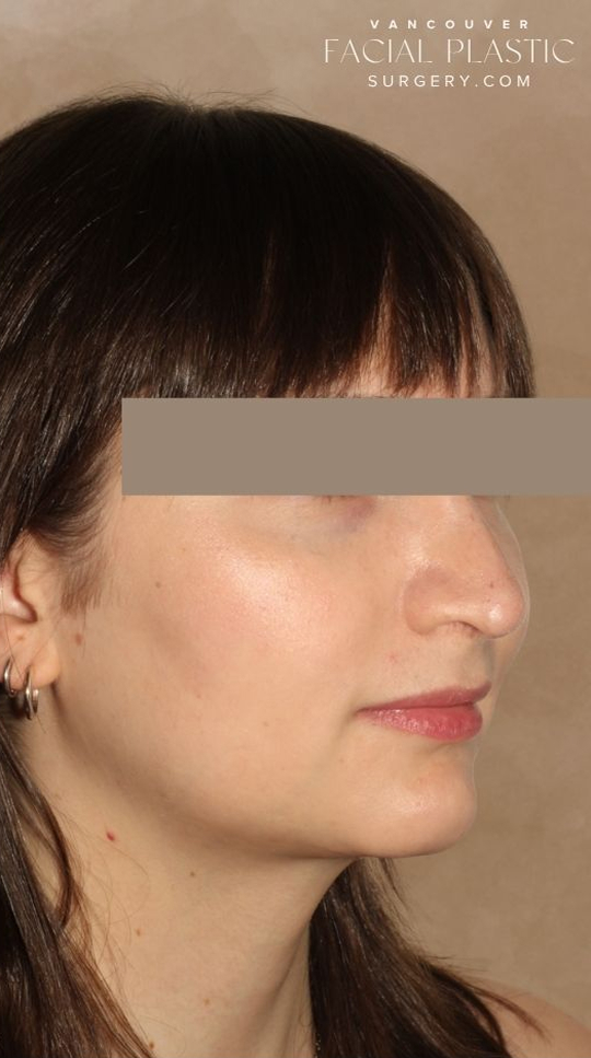 Rhinoplasty Before & After Image