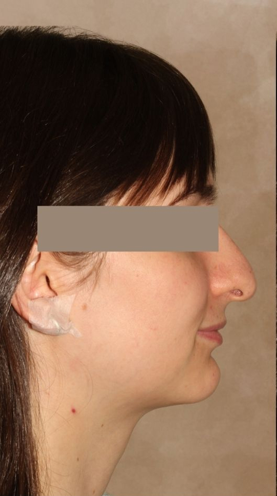 Rhinoplasty Before & After Image