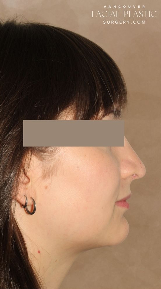 Rhinoplasty Before & After Image