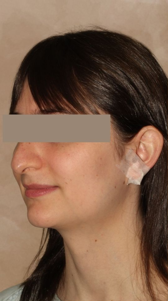 Rhinoplasty Before & After Image