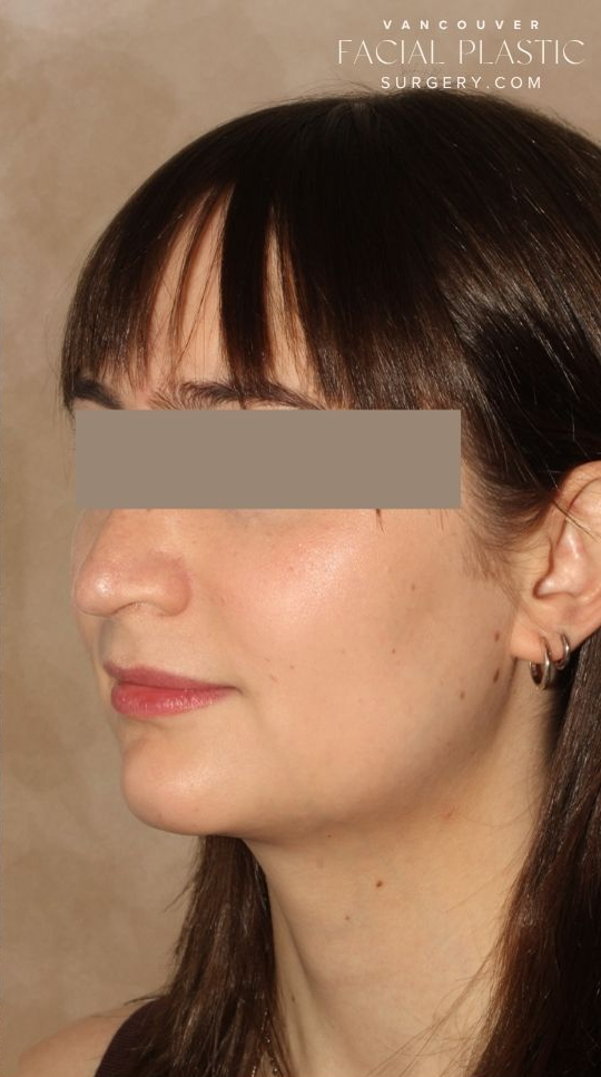 Rhinoplasty Before & After Image