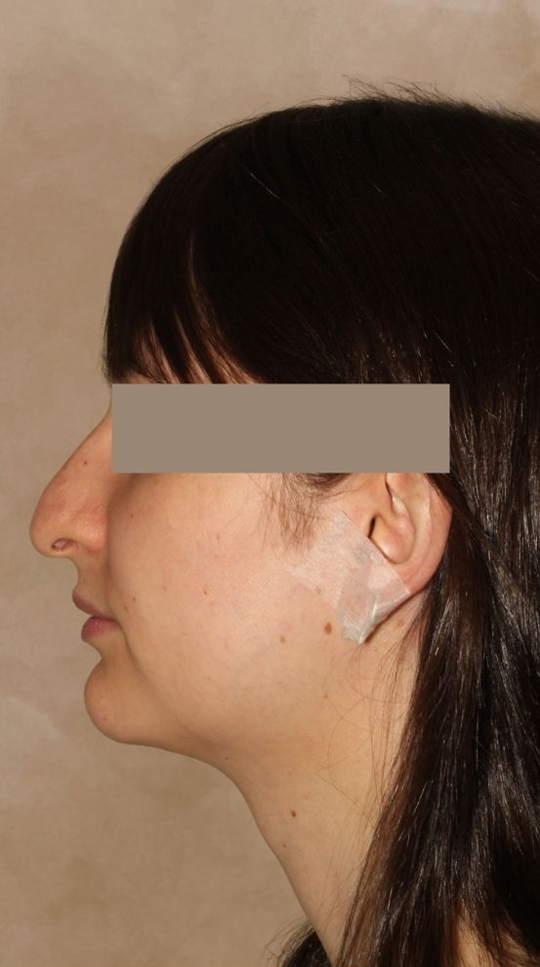 Rhinoplasty Before & After Image