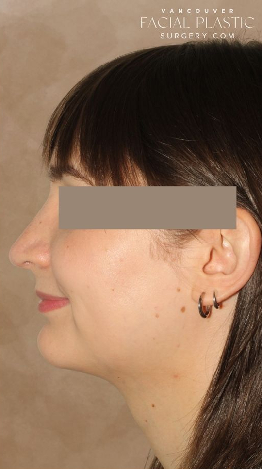 Rhinoplasty Before & After Image